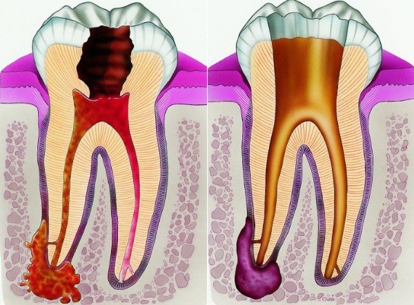 Стоматология 6 Granuliruyushhiy i granulematoznyy periodontity 1